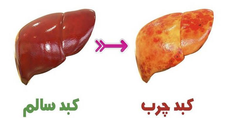 دریافت شما درگیر کبد چرب هستید